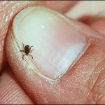 Permalink to: What do you do if you find a tick on your skin or on a child? TickonThumb